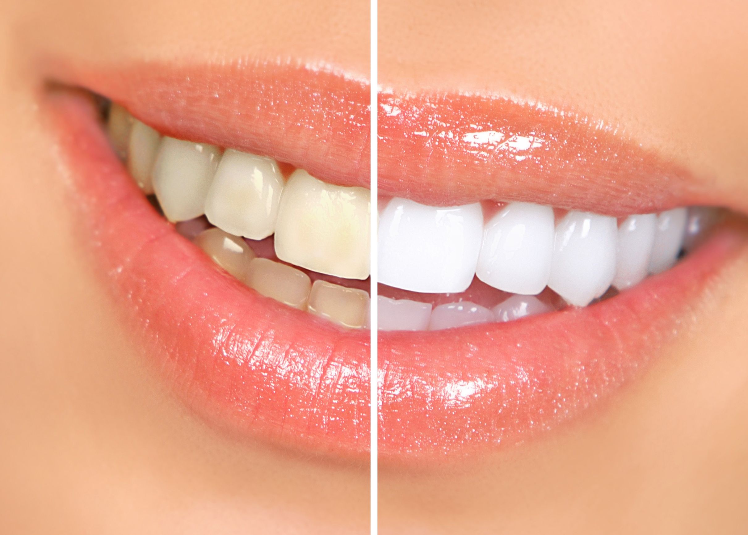 3 Things Getting Veneers in Keizer OR Can Do for You