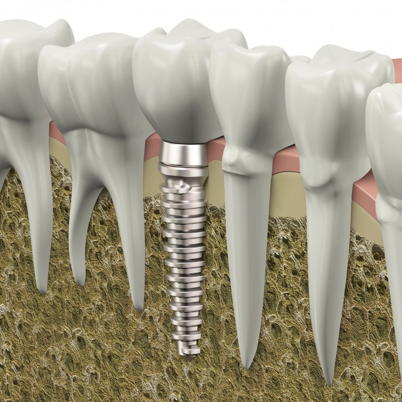 Preparing for Dental Implant Surgery in Indianapolis IN